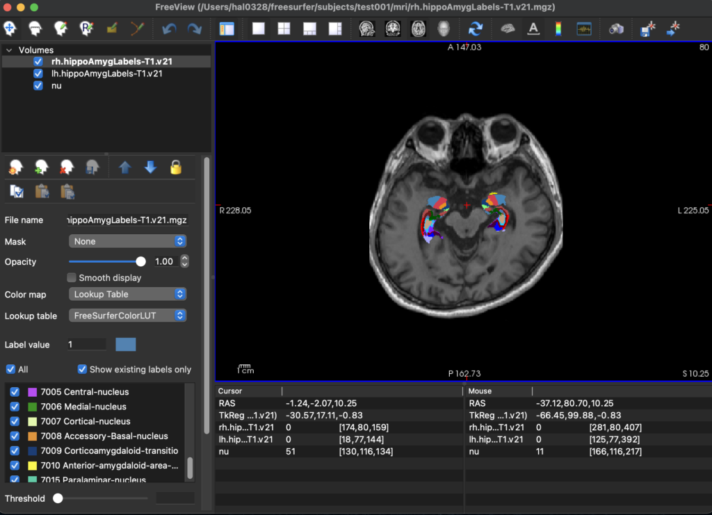 Freesurfer 海馬サブフィールド 扁桃体のセグメンテーション Halnote